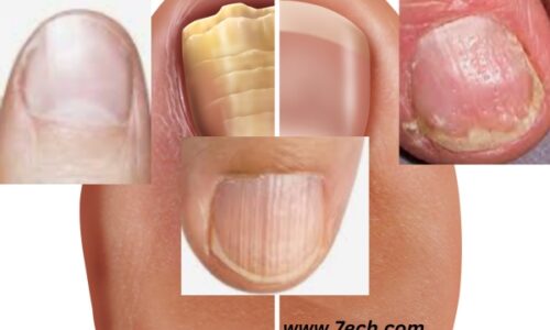 Nail Pitting: Understanding the Indentations on Your Nails